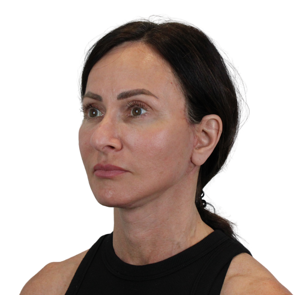 Deep Plane Facelift Before & After Gallery - Patient 329237 - Image 10