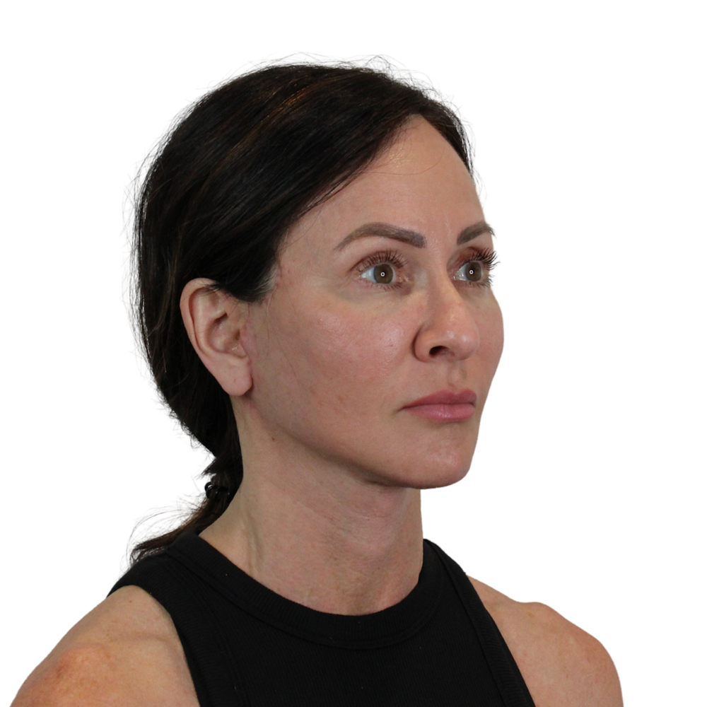Deep Plane Facelift Before & After Gallery - Patient 329237 - Image 4