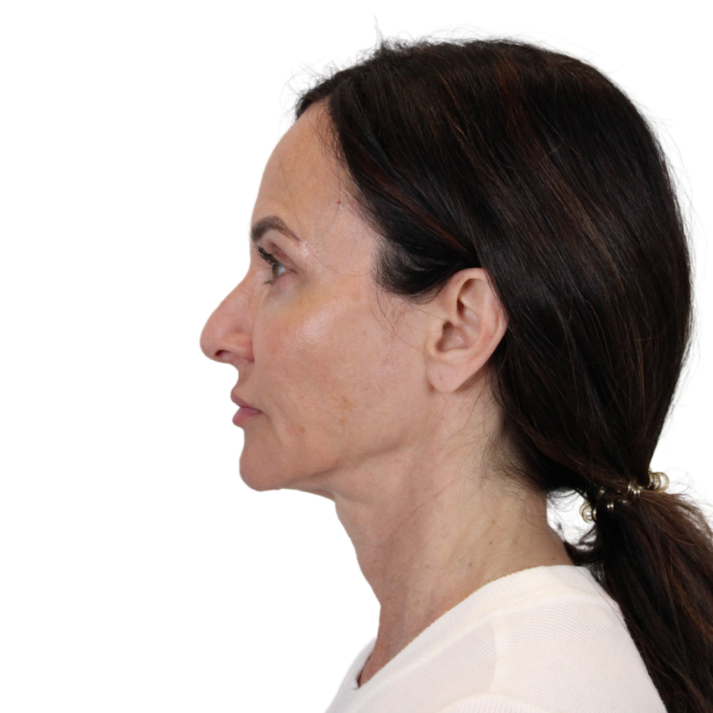 Deep Plane Facelift Before & After Gallery - Patient 329237 - Image 11