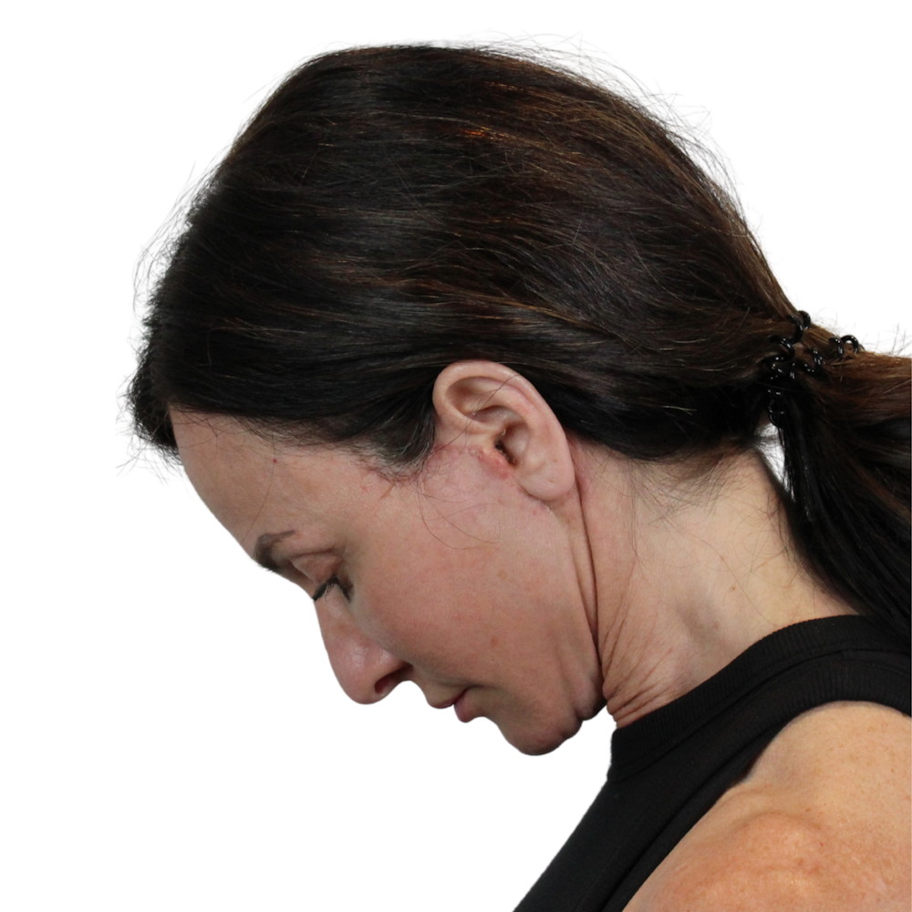 Deep Plane Facelift Before & After Gallery - Patient 329237 - Image 14
