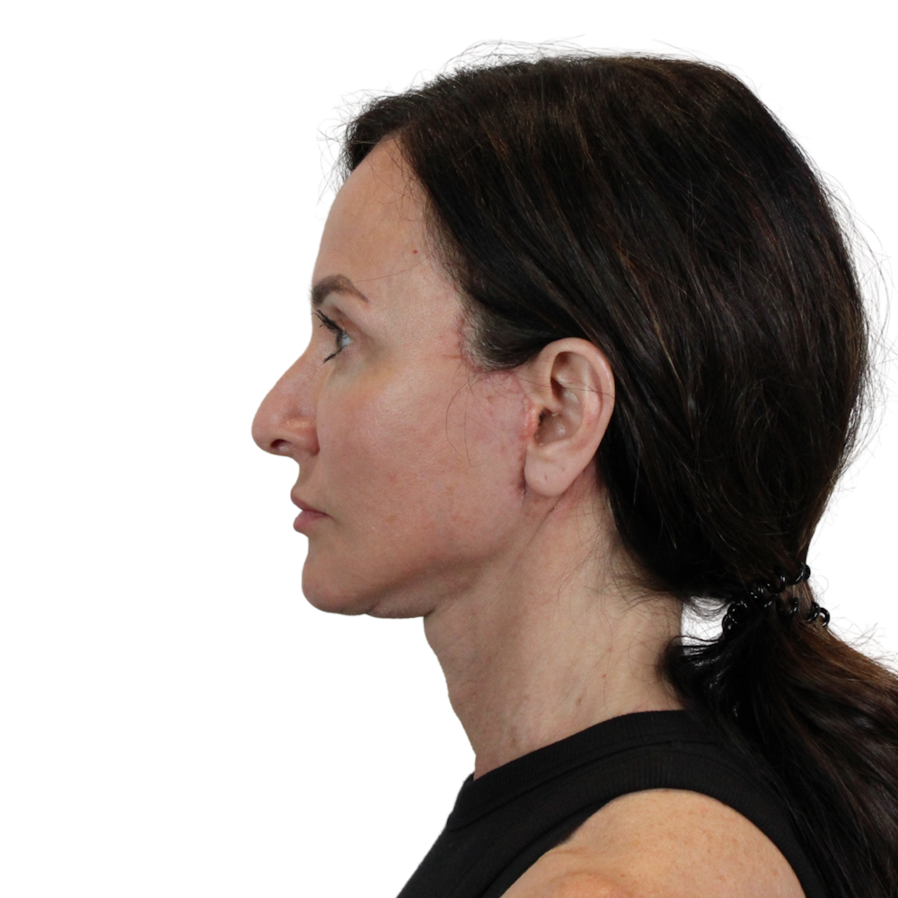 Deep Plane Facelift Before & After Gallery - Patient 329237 - Image 12