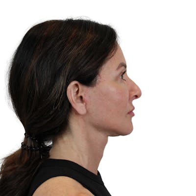 Deep Plane Facelift Before & After Gallery - Patient 329237 - Image 6