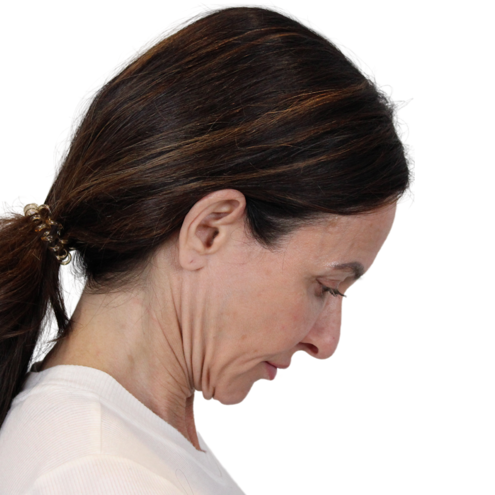Deep Plane Facelift Before & After Gallery - Patient 329237 - Image 7
