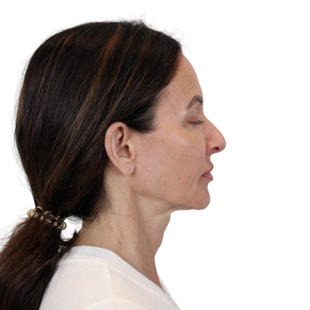Deep Plane Facelift Before & After Gallery - Patient 329237 - Image 5