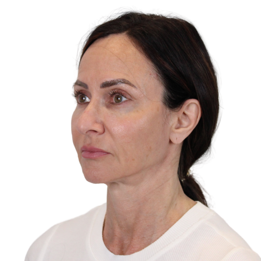 Deep Plane Facelift Before & After Gallery - Patient 329237 - Image 9