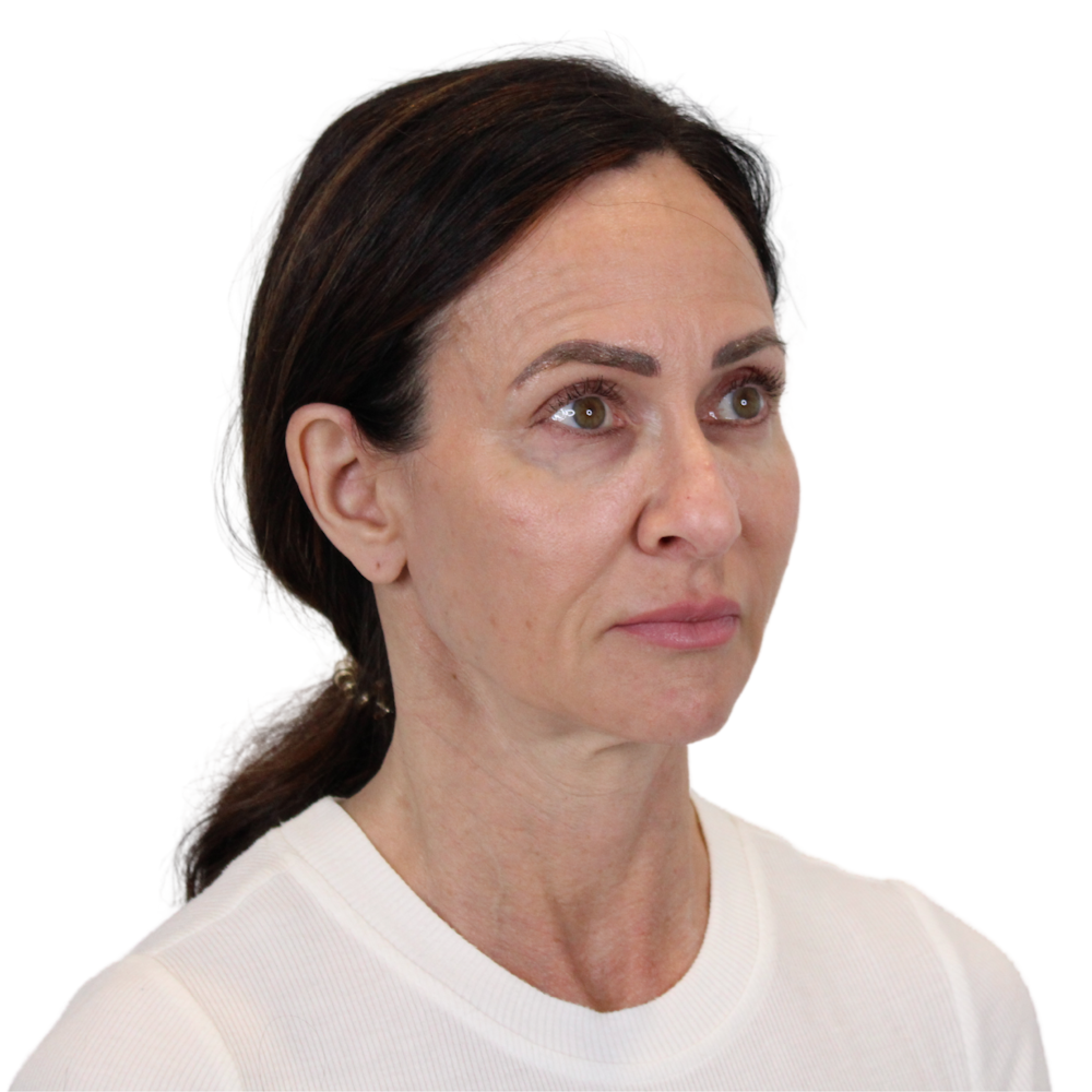 Deep Plane Facelift Before & After Gallery - Patient 329237 - Image 3