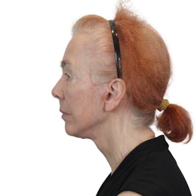 Deep Plane Facelift Before & After Gallery - Patient 669616 - Image 12