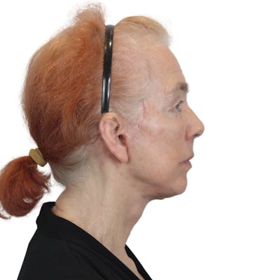 Deep Plane Facelift Before & After Gallery - Patient 669616 - Image 6