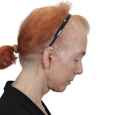 Deep Plane Facelift Before & After Gallery - Patient 669616 - Image 8