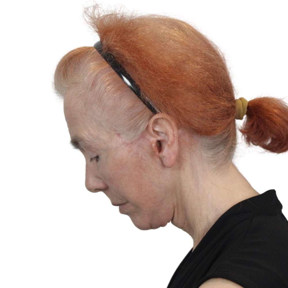 Deep Plane Facelift Before & After Gallery - Patient 669616 - Image 14