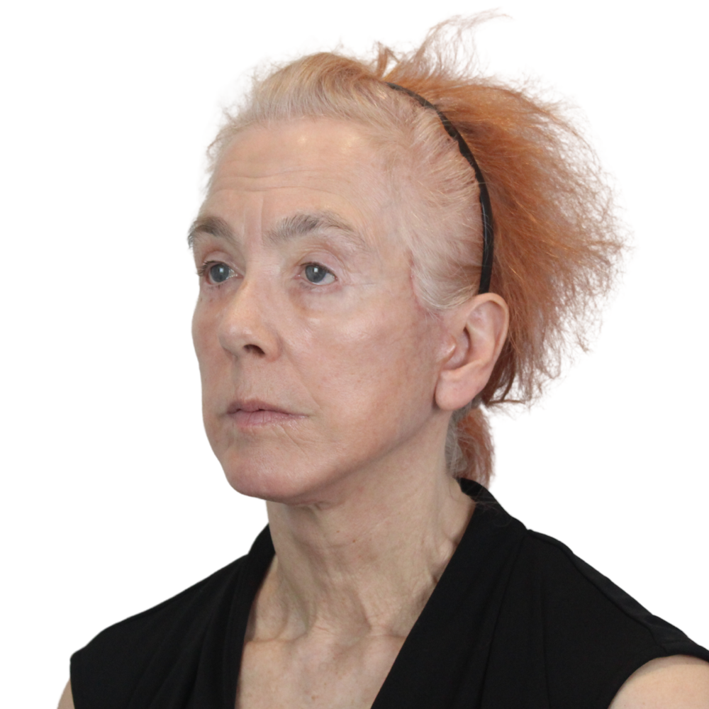 Deep Plane Facelift Before & After Gallery - Patient 669616 - Image 10