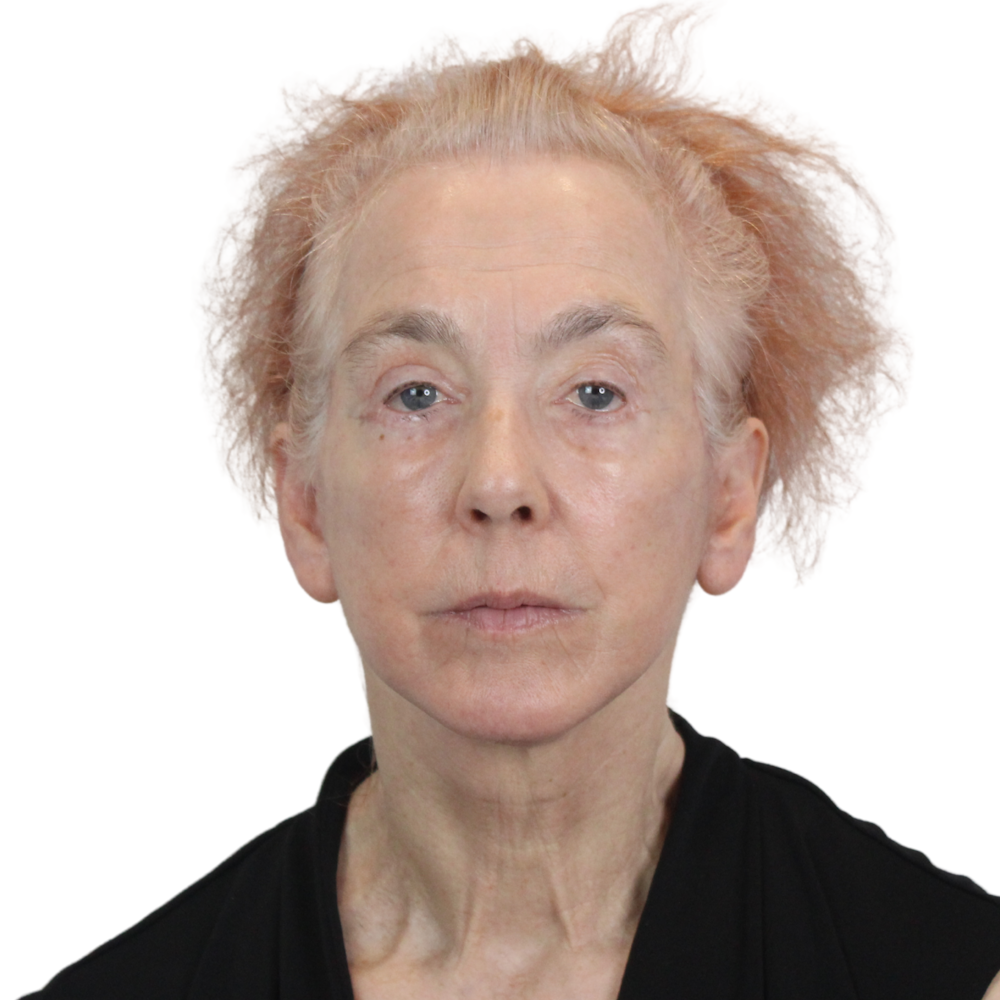 Deep Plane Facelift Before & After Gallery - Patient 669616 - Image 2