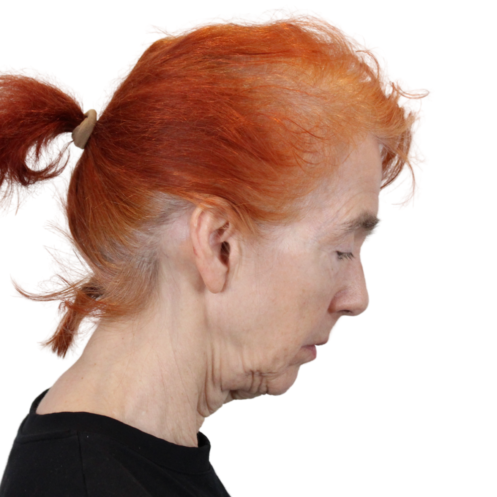 Deep Plane Facelift Before & After Gallery - Patient 669616 - Image 7