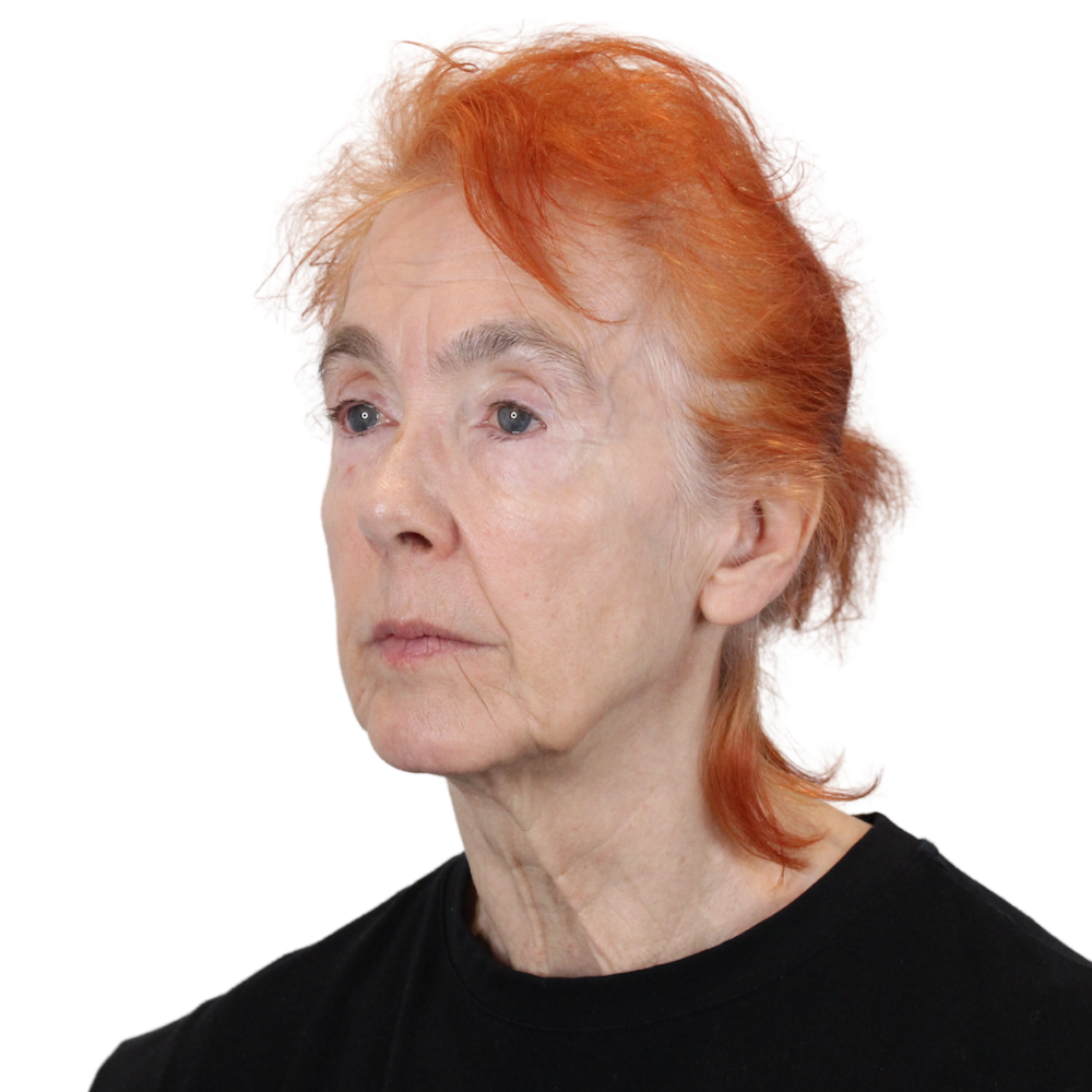 Deep Plane Facelift Before & After Gallery - Patient 669616 - Image 9