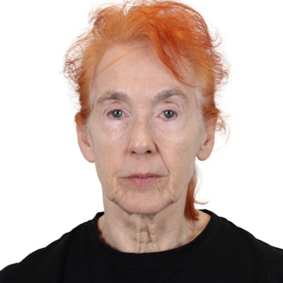 Deep Plane Facelift Before & After Gallery - Patient 669616 - Image 1