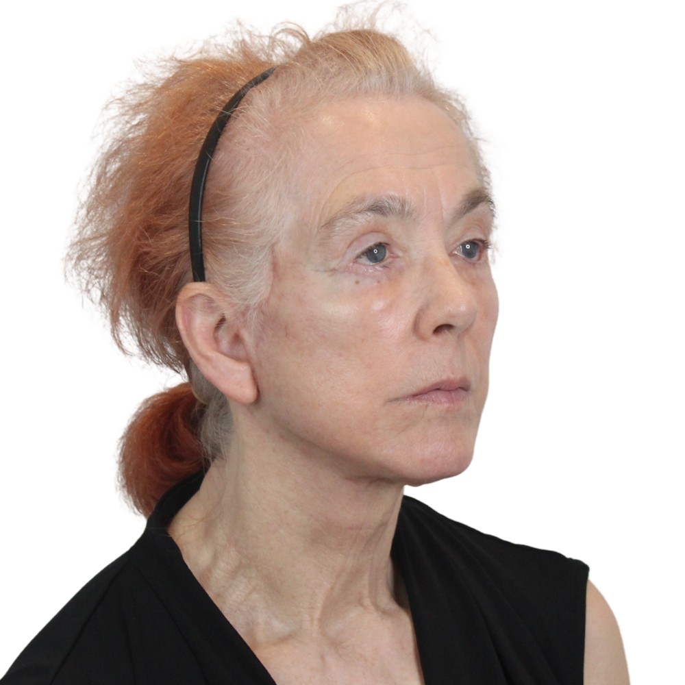 Deep Plane Facelift Before & After Gallery - Patient 669616 - Image 4