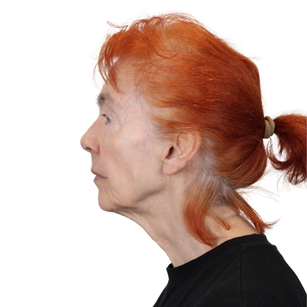 Deep Plane Facelift Before & After Gallery - Patient 669616 - Image 11