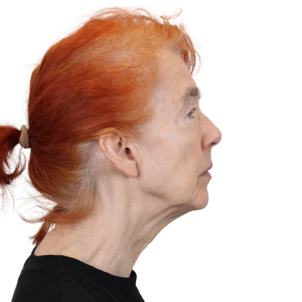 Deep Plane Facelift Before & After Gallery - Patient 669616 - Image 5