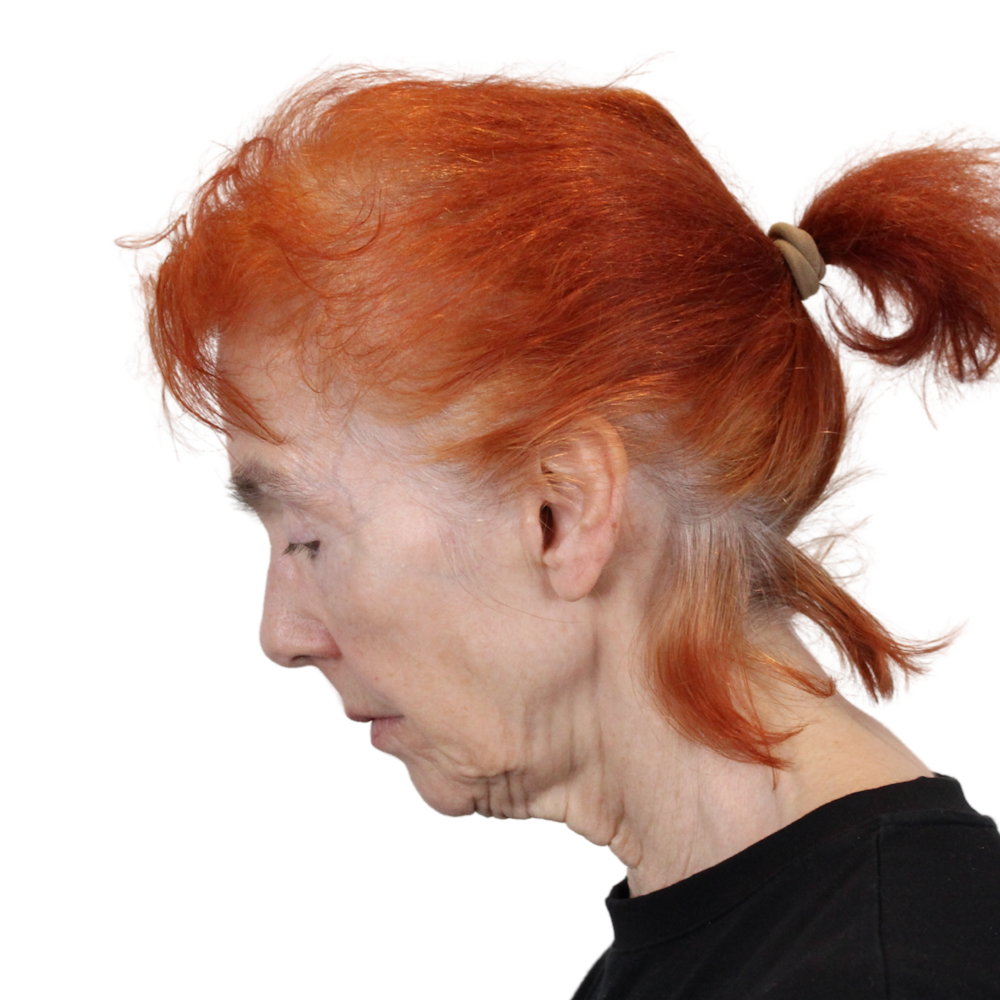 Deep Plane Facelift Before & After Gallery - Patient 669616 - Image 13
