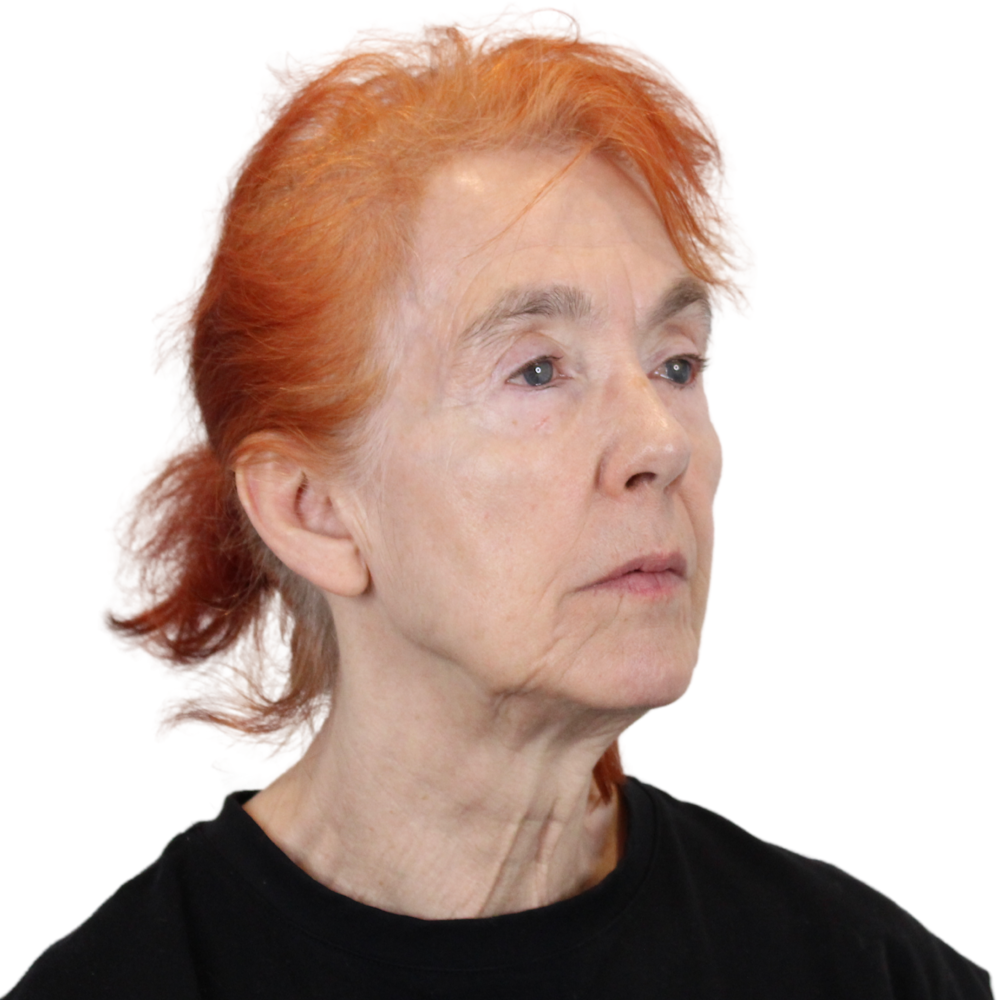Deep Plane Facelift Before & After Gallery - Patient 669616 - Image 3