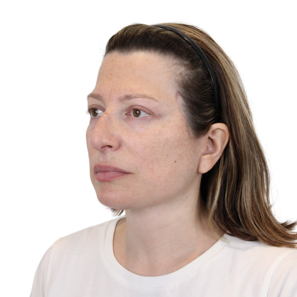 Deep Plane Facelift Before & After Gallery - Patient 163165 - Image 8
