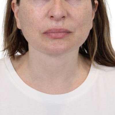Deep Plane Facelift Before & After Gallery - Patient 163165 - Image 12