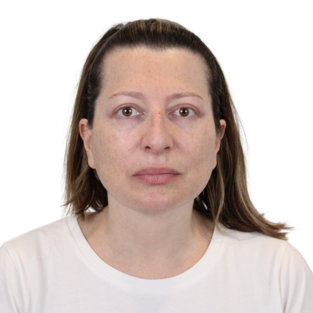 Deep Plane Facelift Before & After Gallery - Patient 163165 - Image 2
