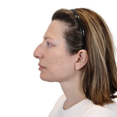 Deep Plane Facelift Before & After Gallery - Patient 163165 - Image 10