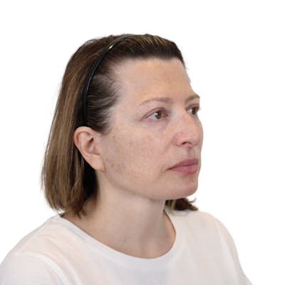 Deep Plane Facelift Before & After Gallery - Patient 163165 - Image 4