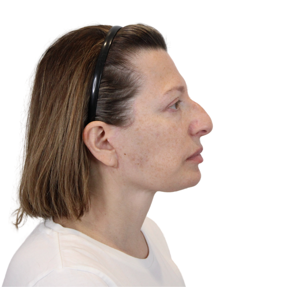 Deep Plane Facelift Before & After Gallery - Patient 163165 - Image 6