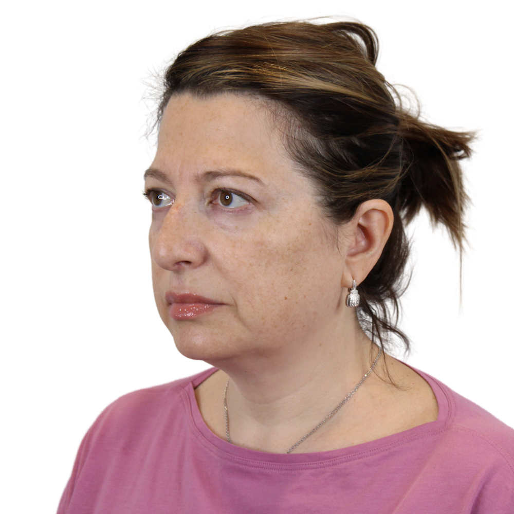 Deep Plane Facelift Before & After Gallery - Patient 163165 - Image 7