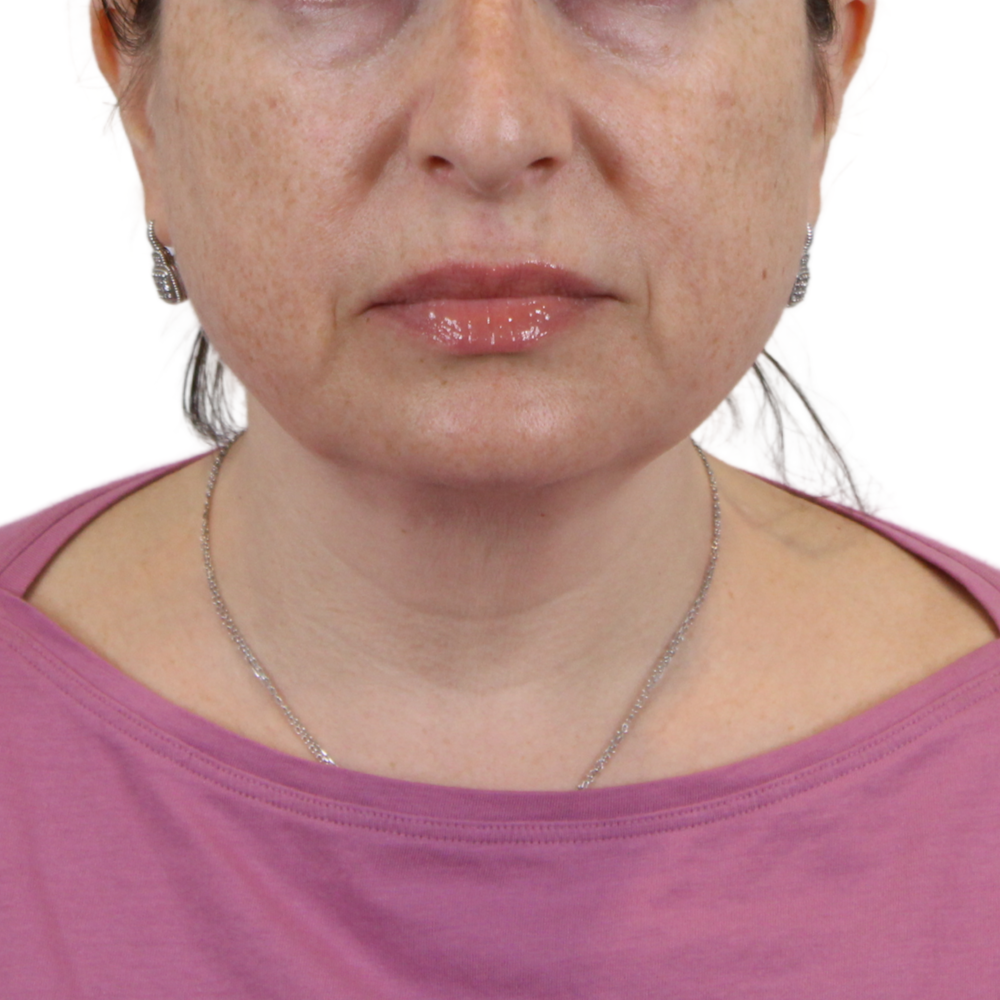 Deep Plane Facelift Before & After Gallery - Patient 163165 - Image 11