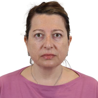 Deep Plane Facelift Before & After Gallery - Patient 163165 - Image 1