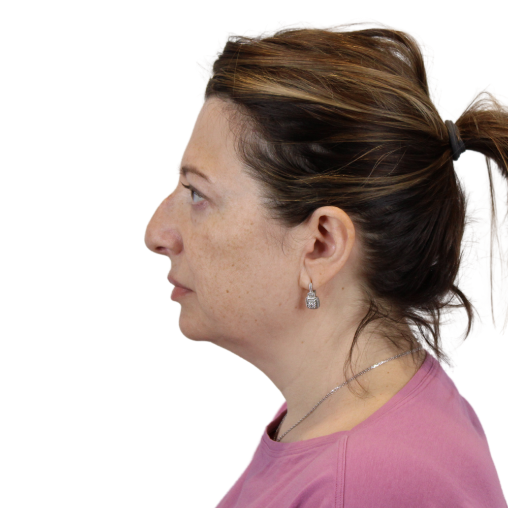Deep Plane Facelift Before & After Gallery - Patient 163165 - Image 9