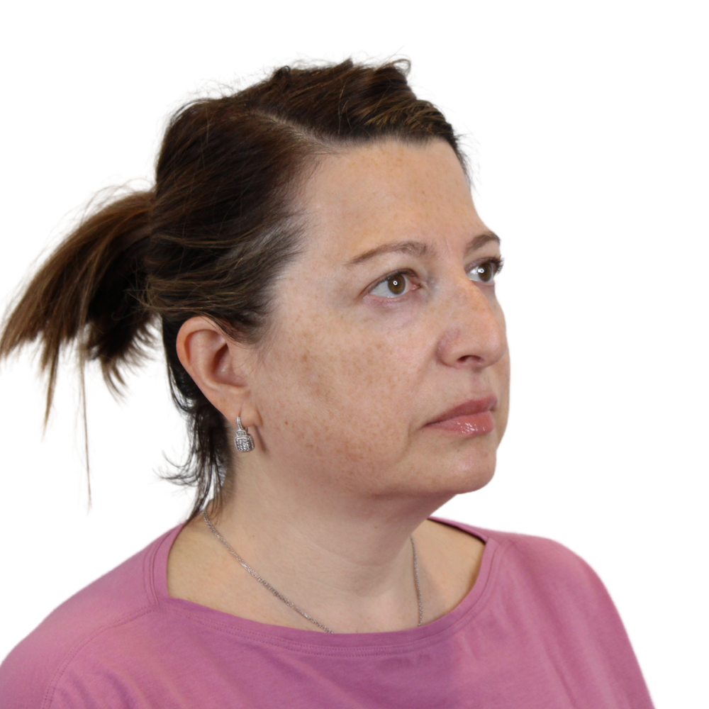 Deep Plane Facelift Before & After Gallery - Patient 163165 - Image 3