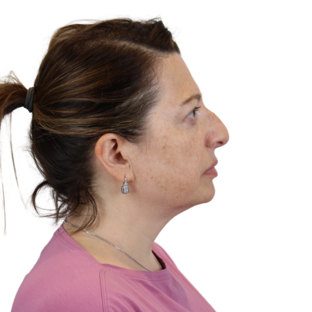 Deep Plane Facelift Before & After Gallery - Patient 163165 - Image 5