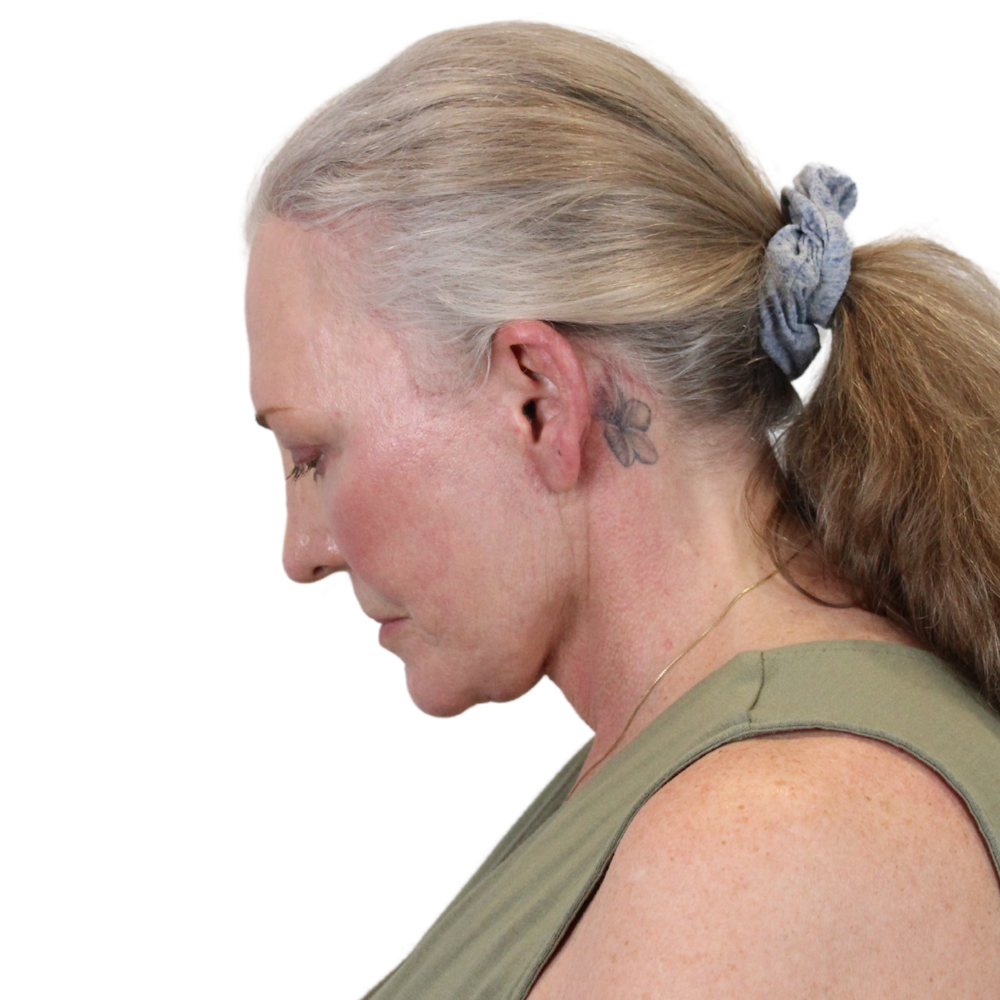 Deep Plane Facelift Before & After Gallery - Patient 226378 - Image 14