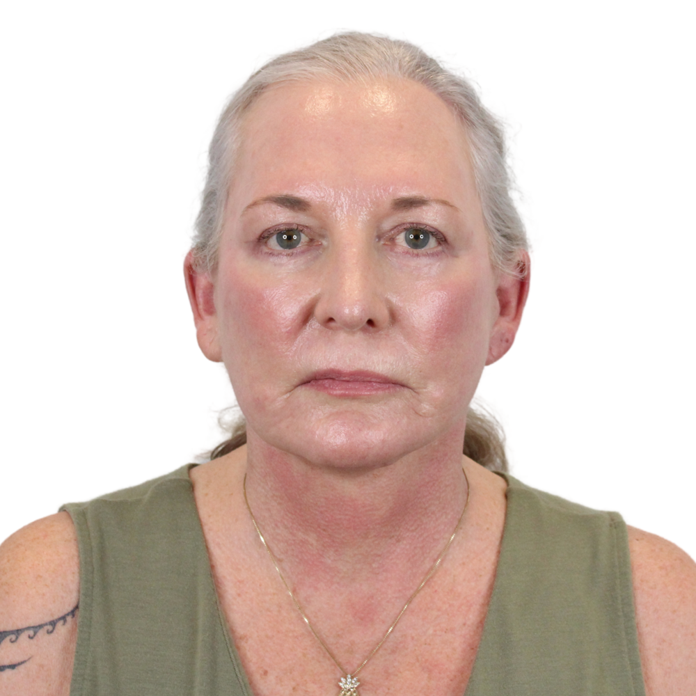 Deep Plane Facelift Before & After Gallery - Patient 226378 - Image 2