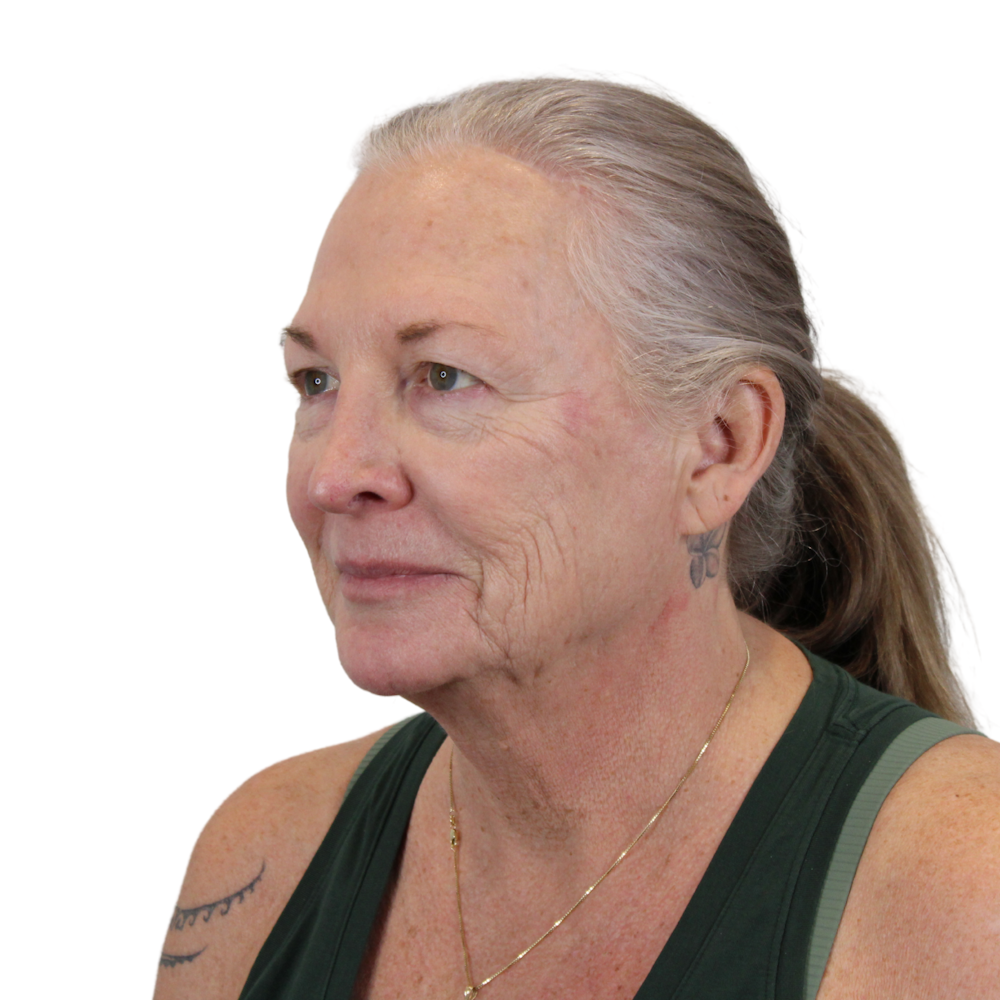 Deep Plane Facelift Before & After Gallery - Patient 226378 - Image 9