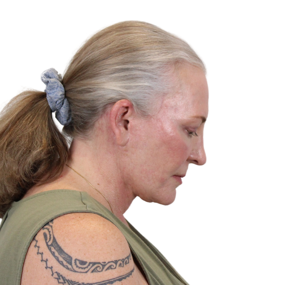 Deep Plane Facelift Before & After Gallery - Patient 226378 - Image 8