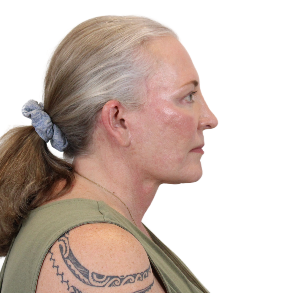 Deep Plane Facelift Before & After Gallery - Patient 226378 - Image 6