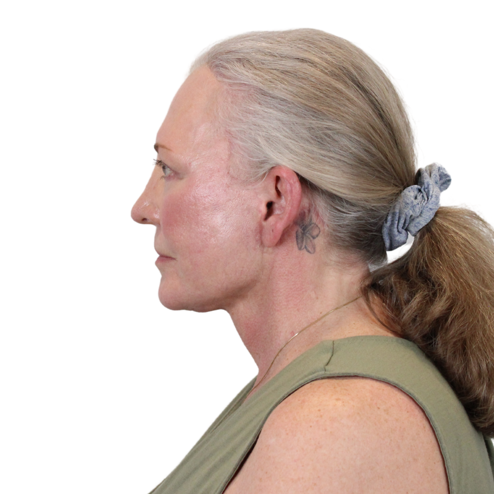 Deep Plane Facelift Before & After Gallery - Patient 226378 - Image 12