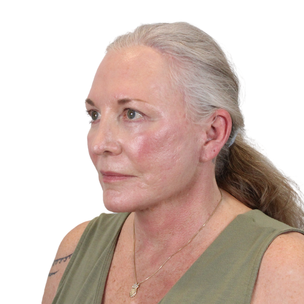 Deep Plane Facelift Before & After Gallery - Patient 226378 - Image 10