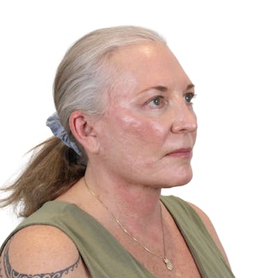 Deep Plane Facelift Before & After Gallery - Patient 226378 - Image 4