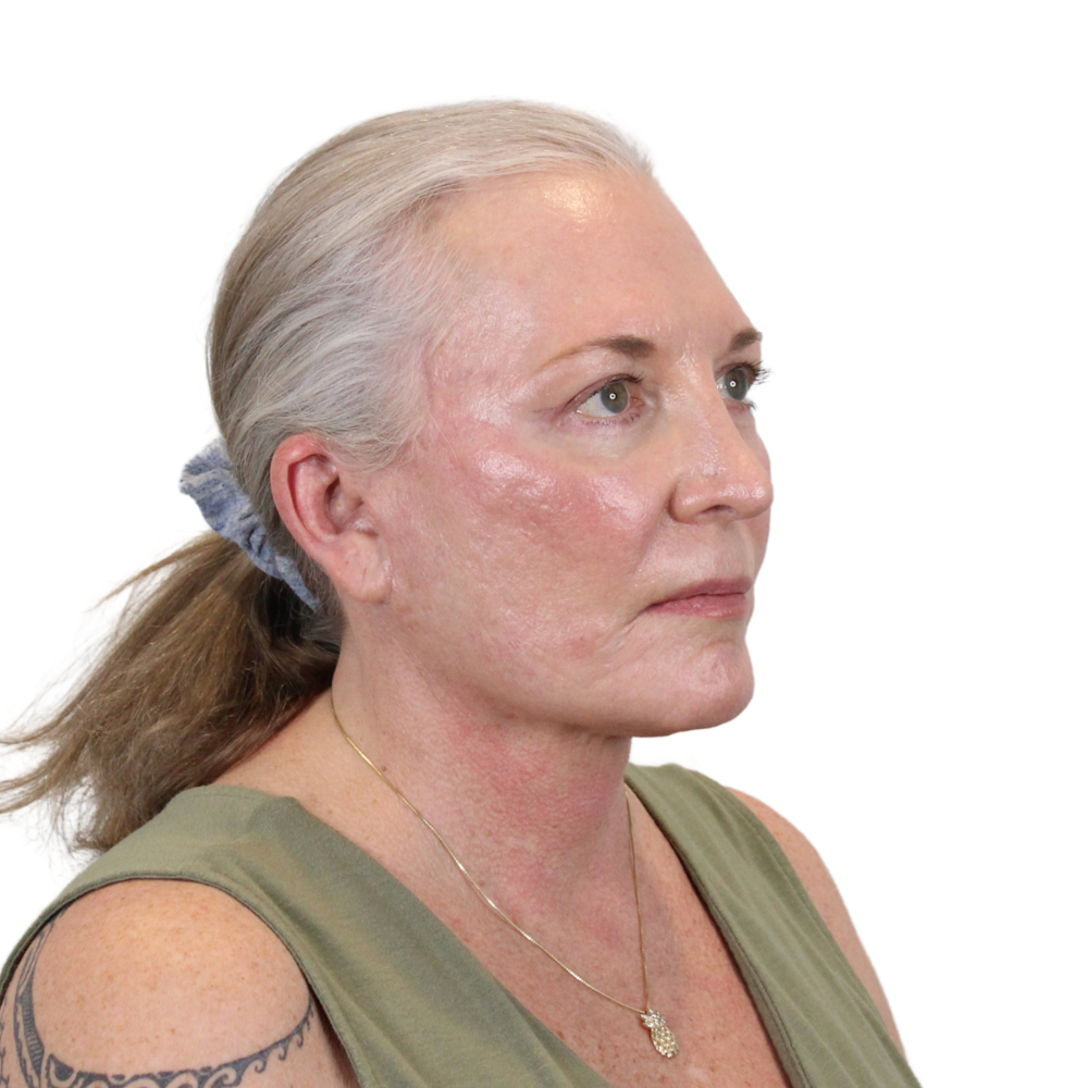 Deep Plane Facelift Before & After Gallery - Patient 226378 - Image 4