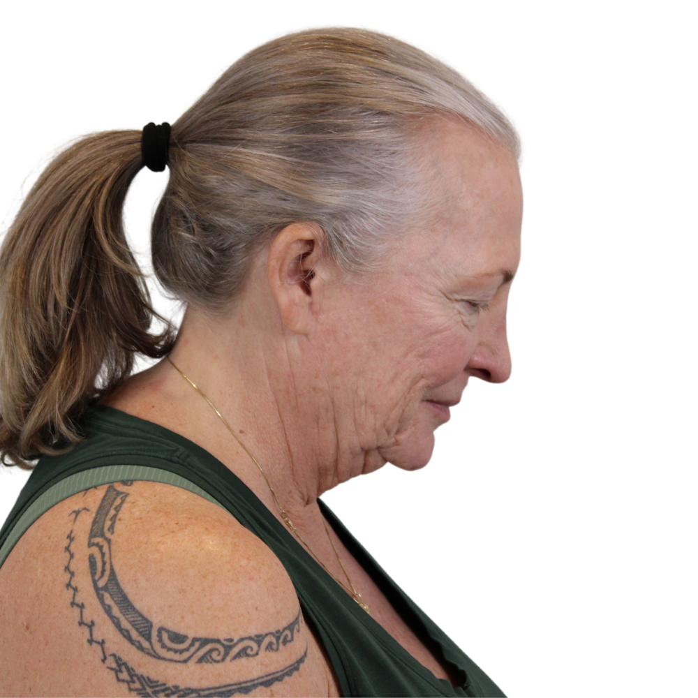 Deep Plane Facelift Before & After Gallery - Patient 226378 - Image 7