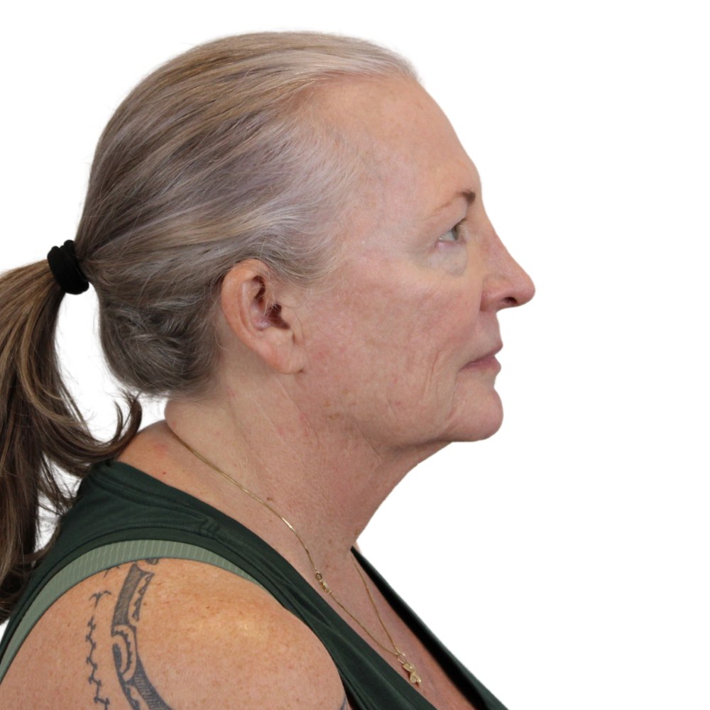 Deep Plane Facelift Before & After Gallery - Patient 226378 - Image 5