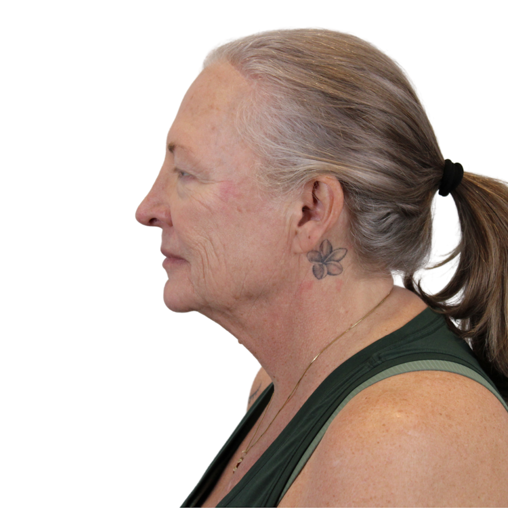 Deep Plane Facelift Before & After Gallery - Patient 226378 - Image 11