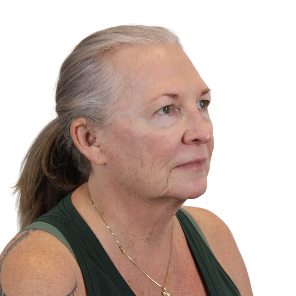 Deep Plane Facelift Before & After Gallery - Patient 226378 - Image 3