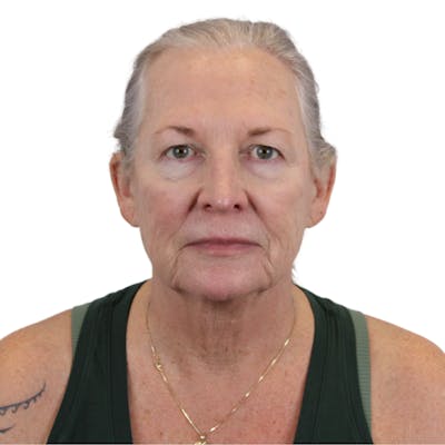 Deep Plane Facelift Before & After Gallery - Patient 226378 - Image 1